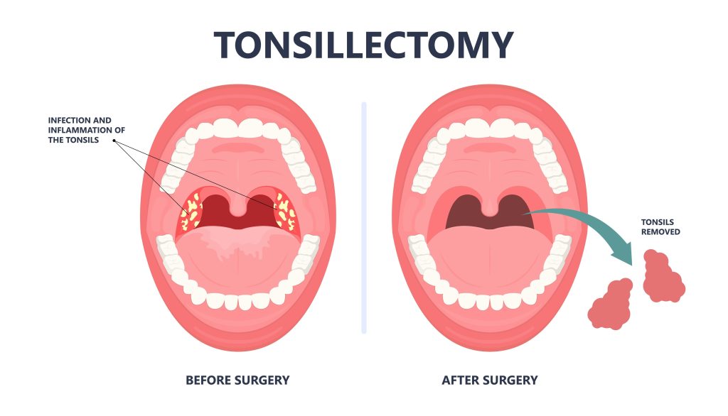Baltimore Tonsillectomy Lawyer