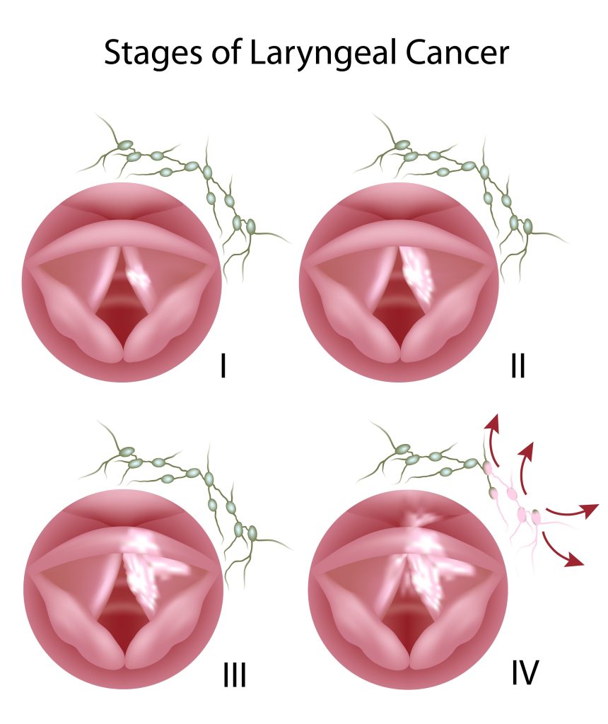 Baltimore Throat Cancer Lawyer