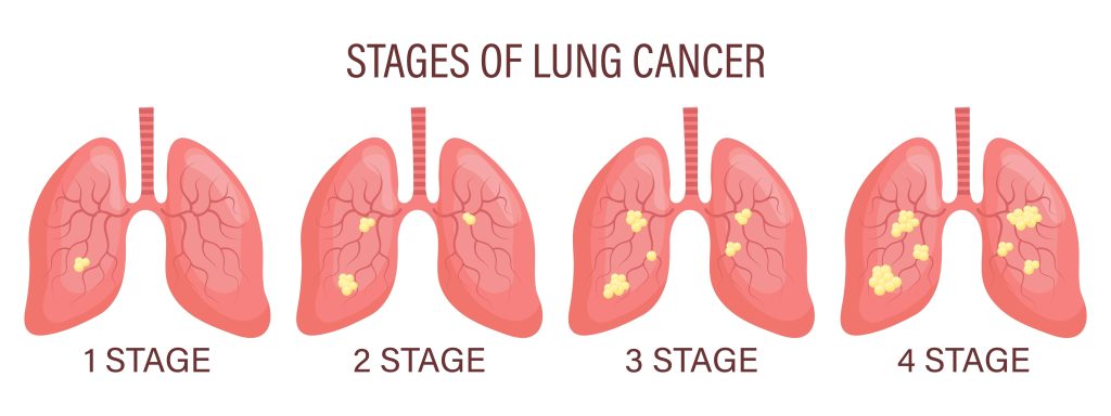 Baltimore Lung Cancer Lawyer