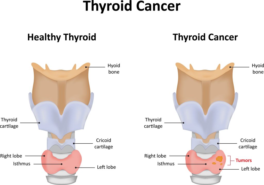 Baltimore Thyroid Cancer Lawyer