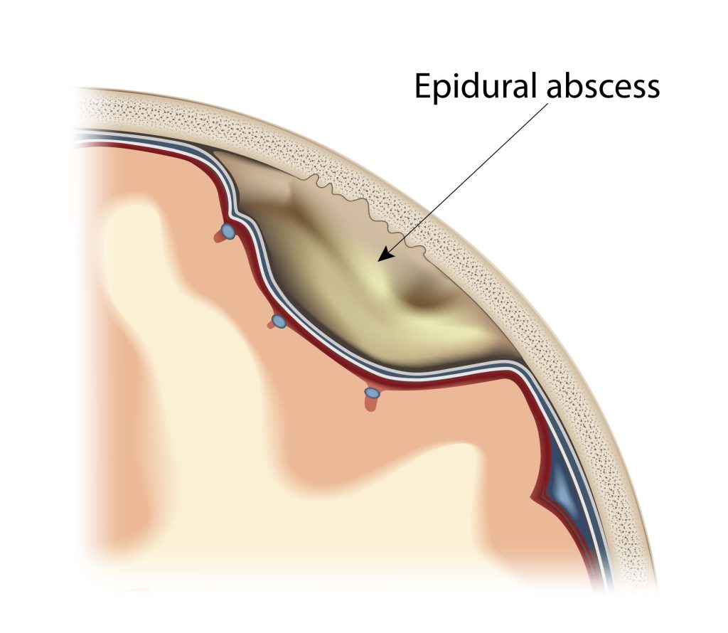 Baltimore Epidural Abscess Lawyer