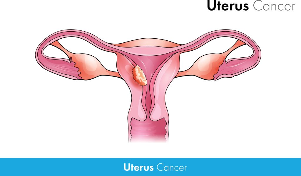 Baltimore Uterine Cancer Lawyer