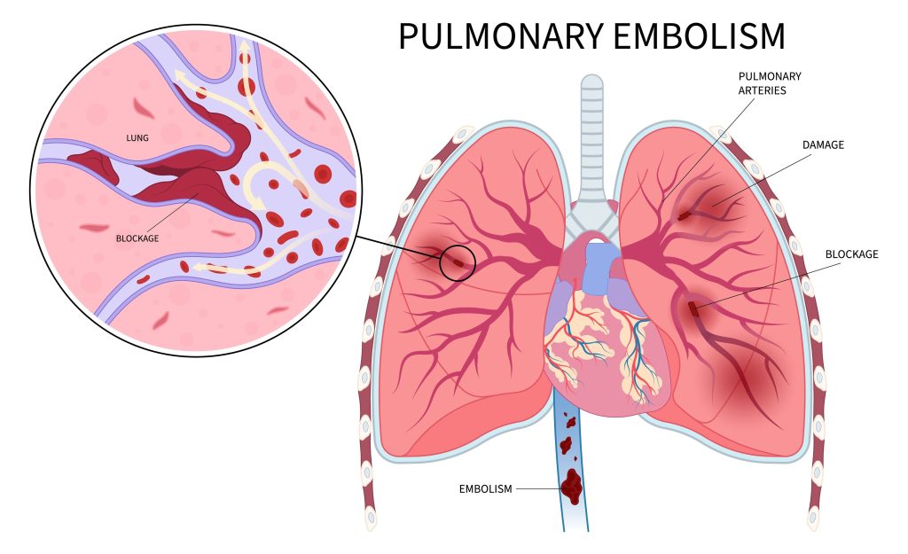Baltimore Pulmonary Embolism Lawyer