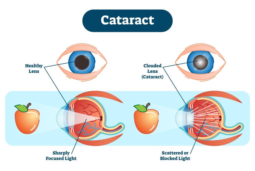 Baltimore Cataract Lawyer