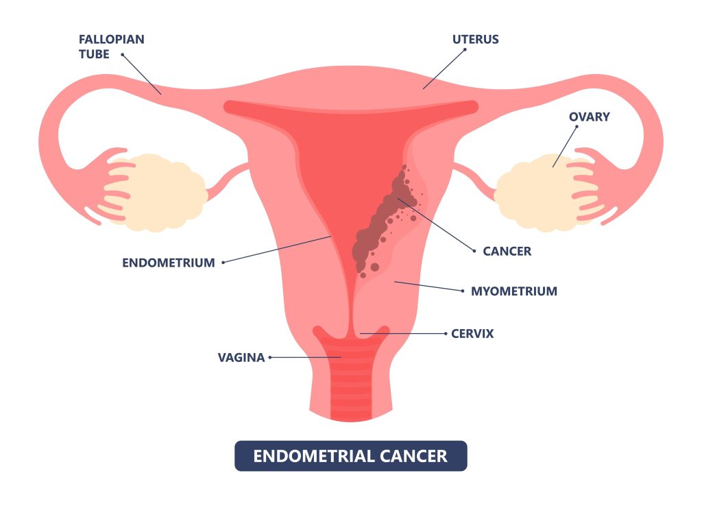 Baltimore Endometrial Cancer Lawyer