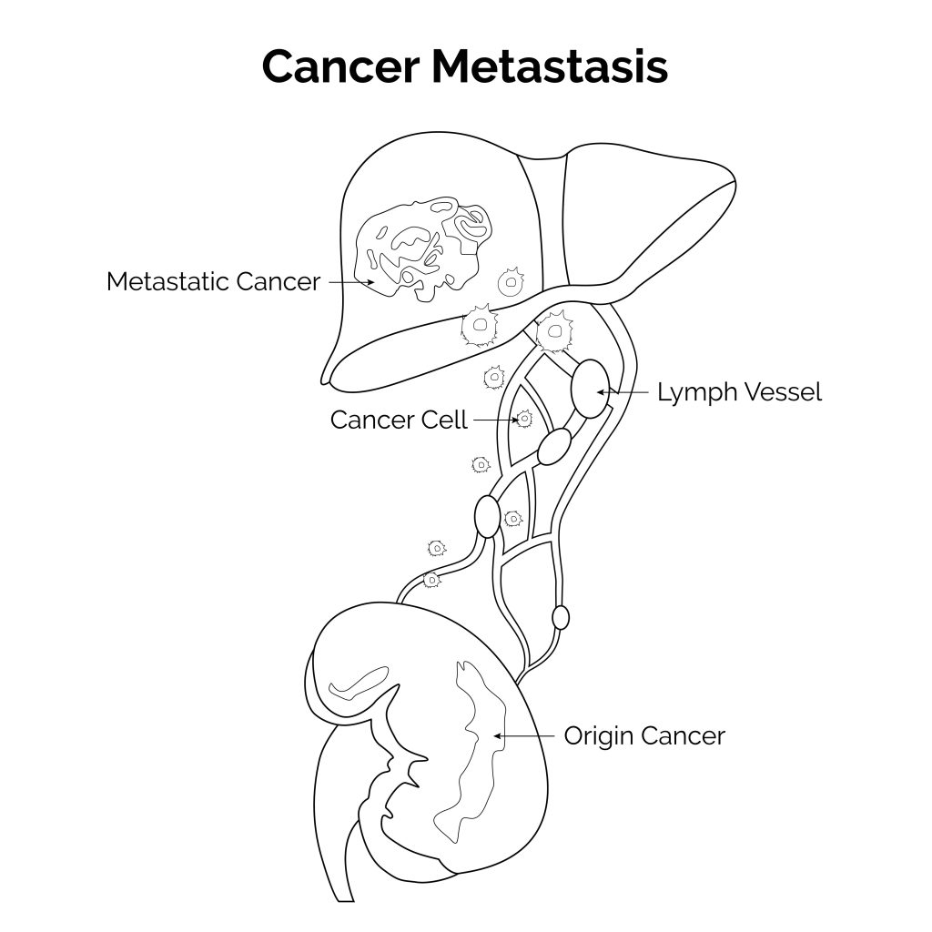 Metastasis