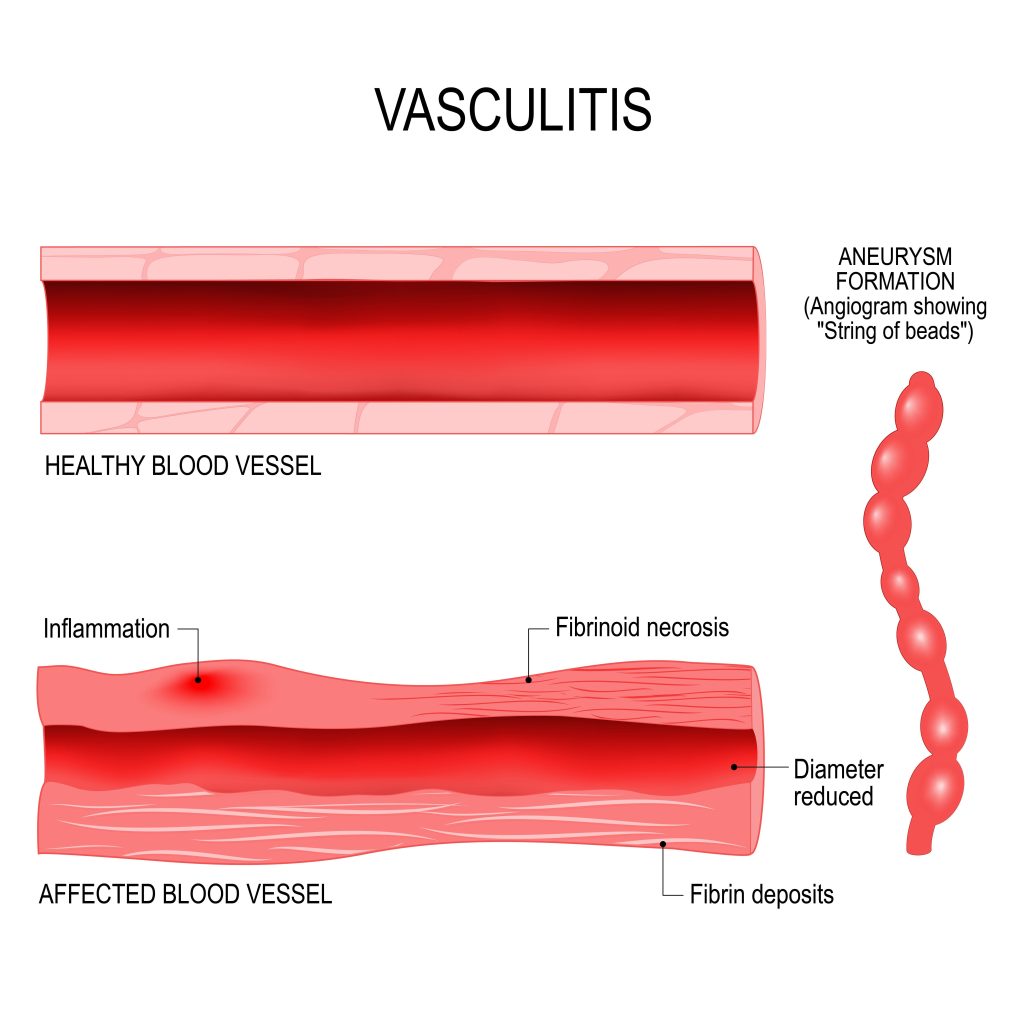 Baltimore Vasculitis Lawyer