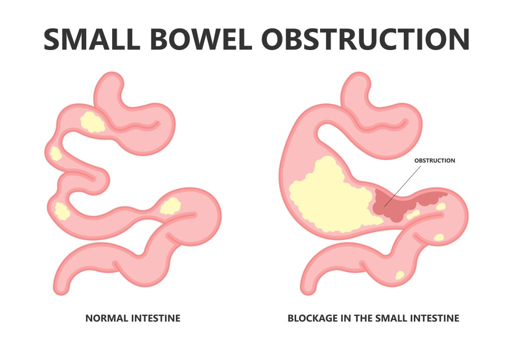 Baltimore Bowel Obstruction Lawyer