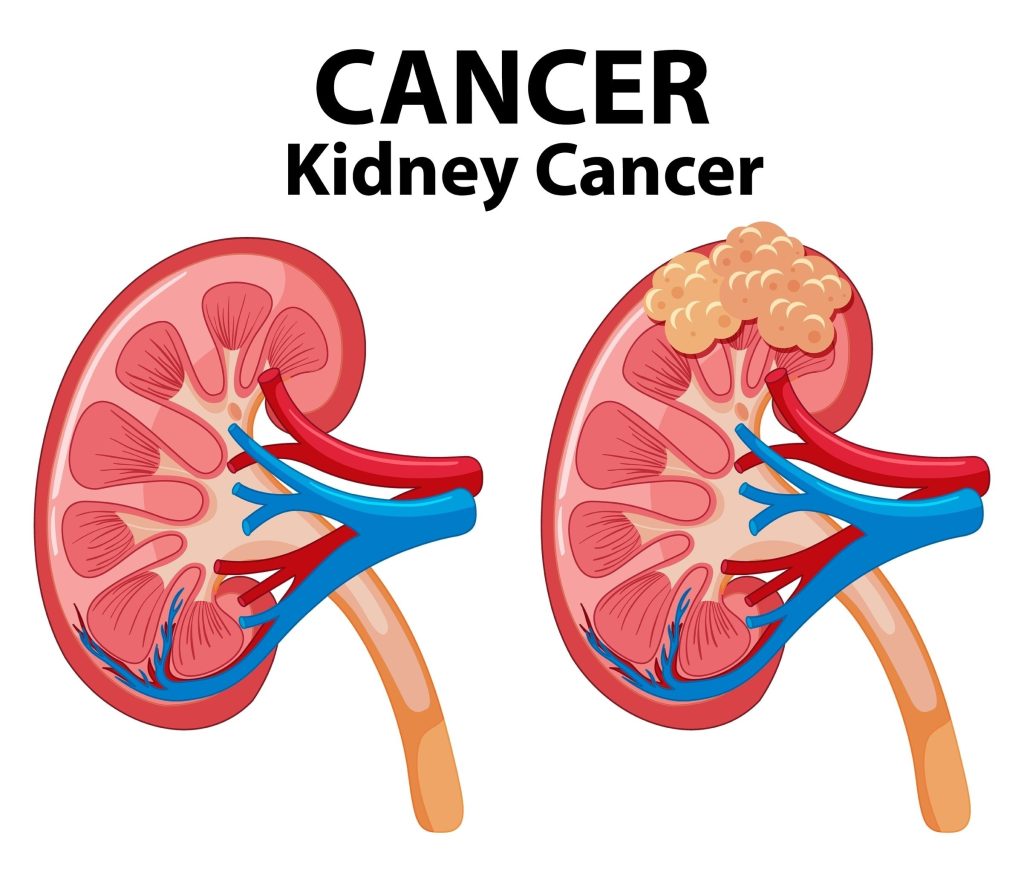 Baltimore Kidney Cancer Lawyer