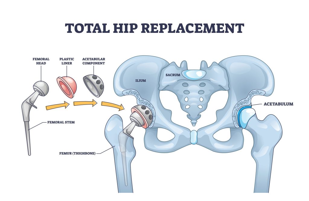 Baltimore Hip Replacement Lawyer