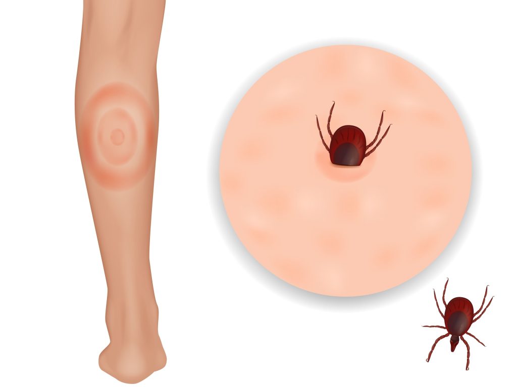 Baltimore Lyme Disease Lawyer