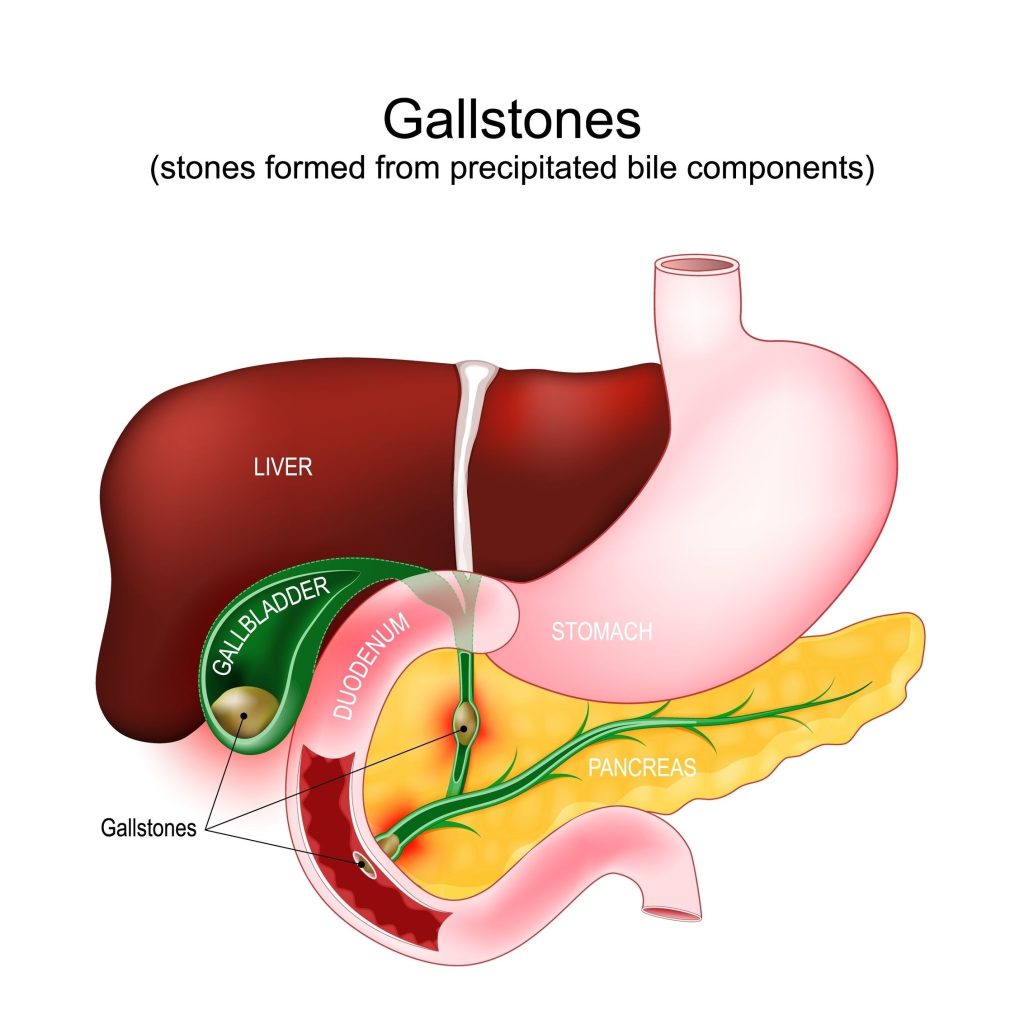 Baltimore Gallbladder Surgery Lawyer