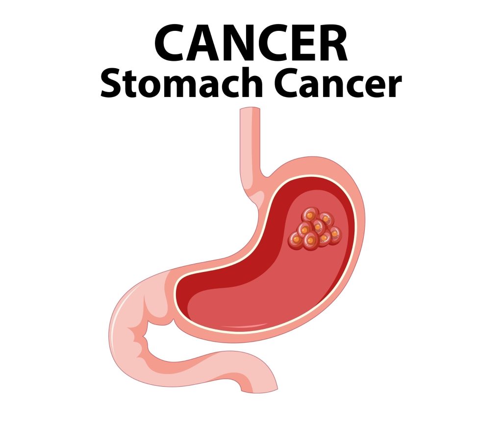 Baltimore Stomach Cancer Lawyer