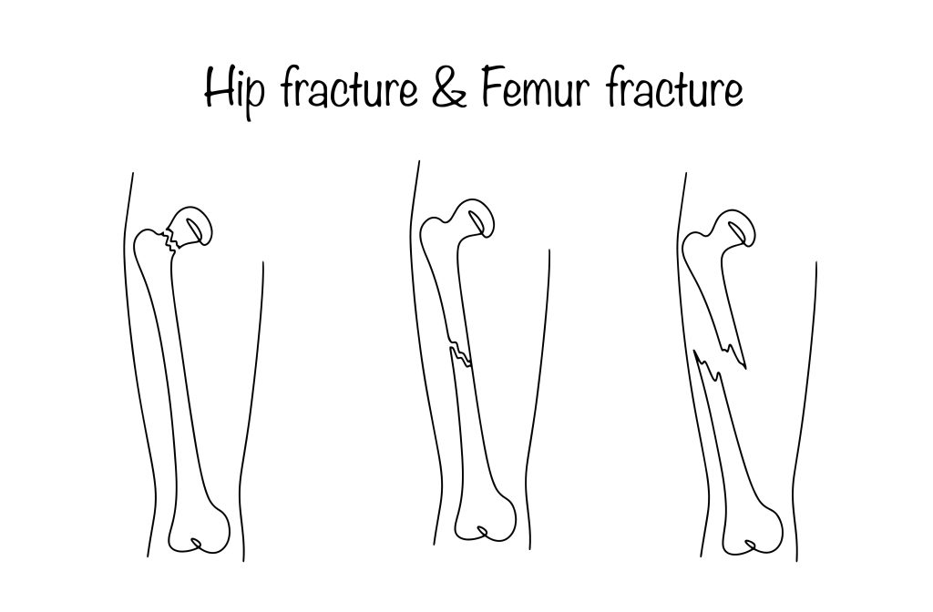 Baltimore Femur Fracture Lawyer