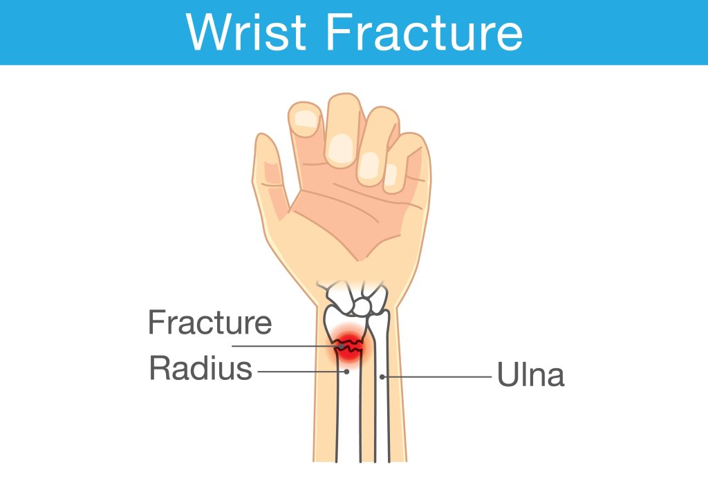 Baltimore Radius Fracture Lawyer