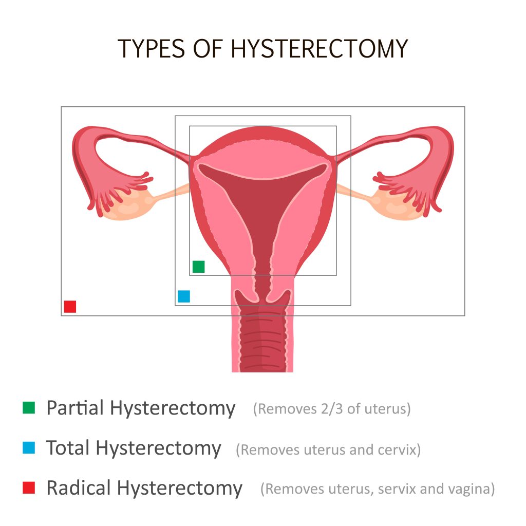 Baltimore Hysterectomy Lawyer