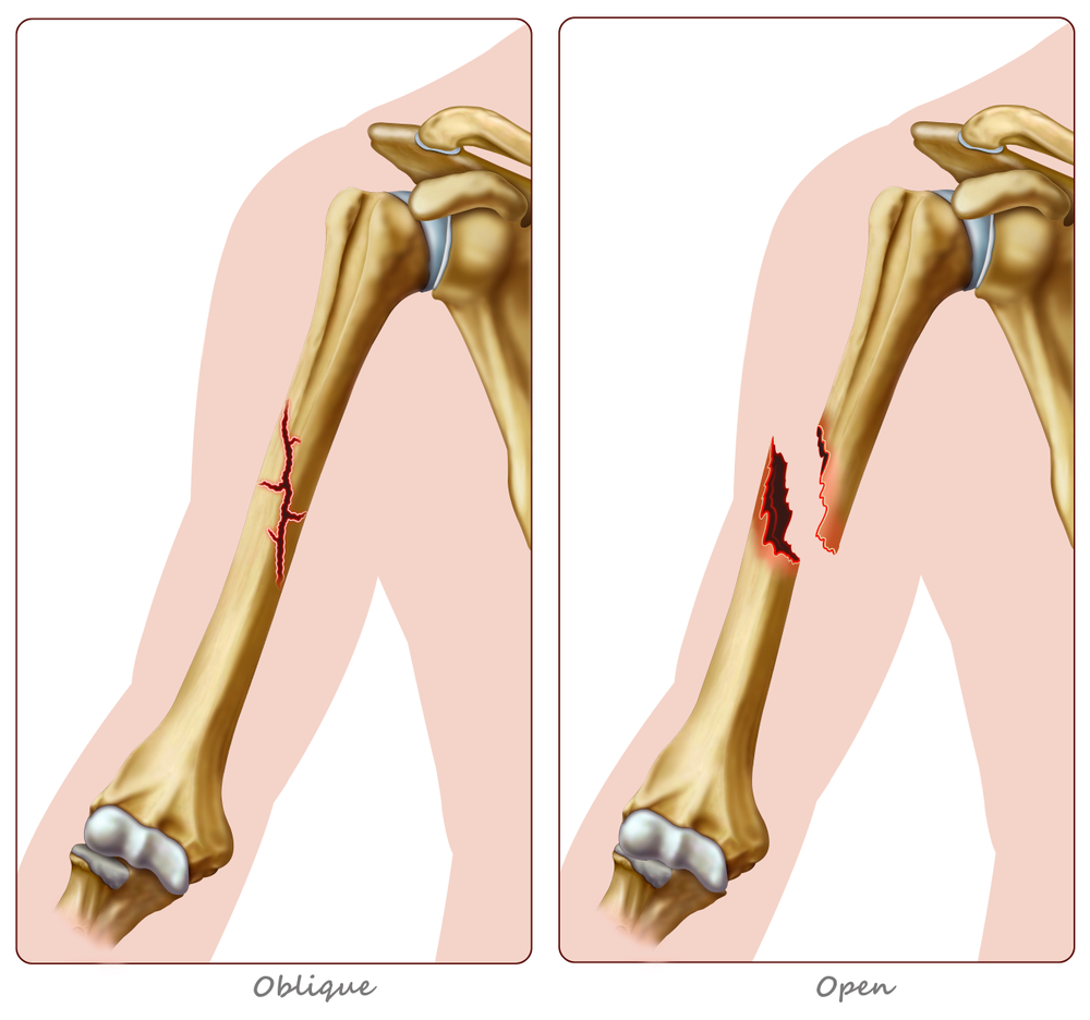 Baltimore Humerus Fracture Lawyer