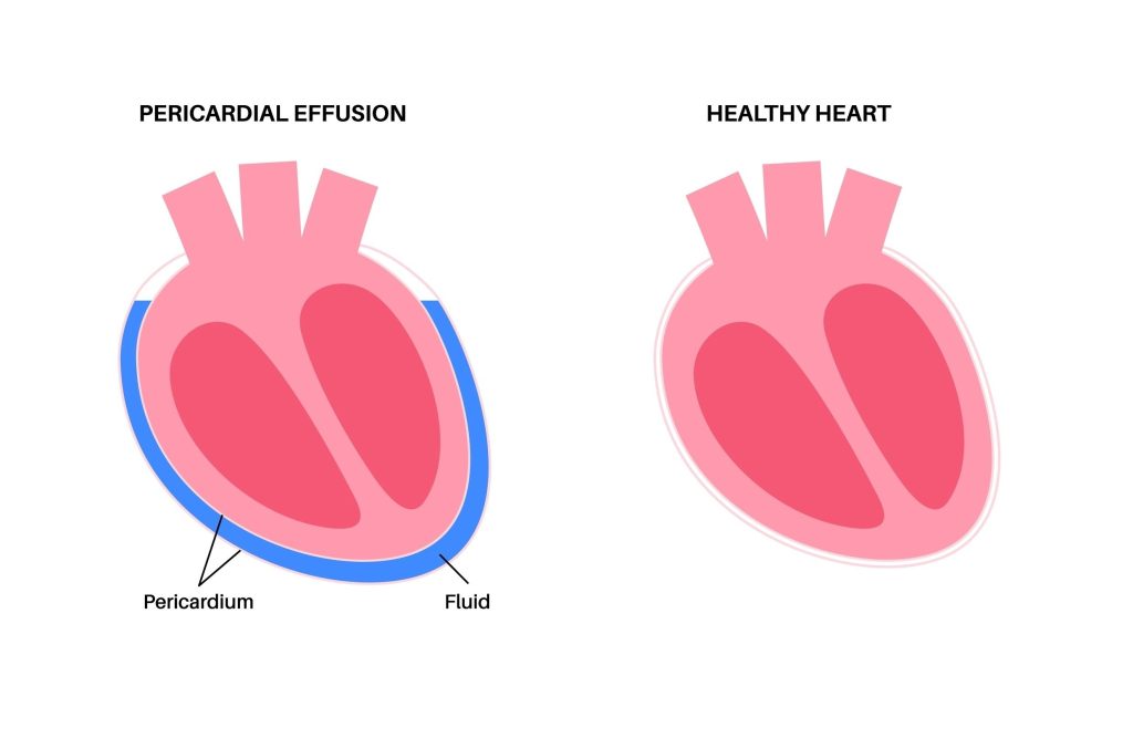 Baltimore Pericardial Effusion Lawyer