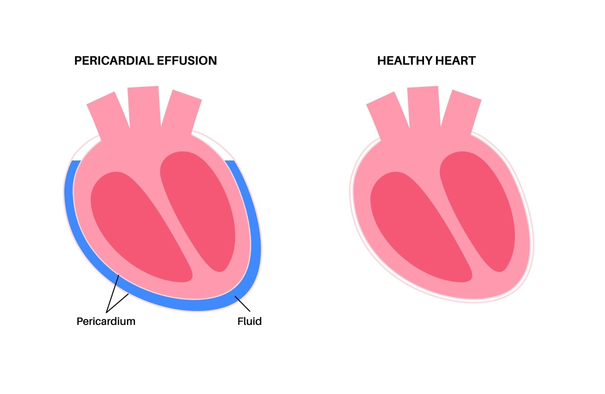 Pericardial Effusion 