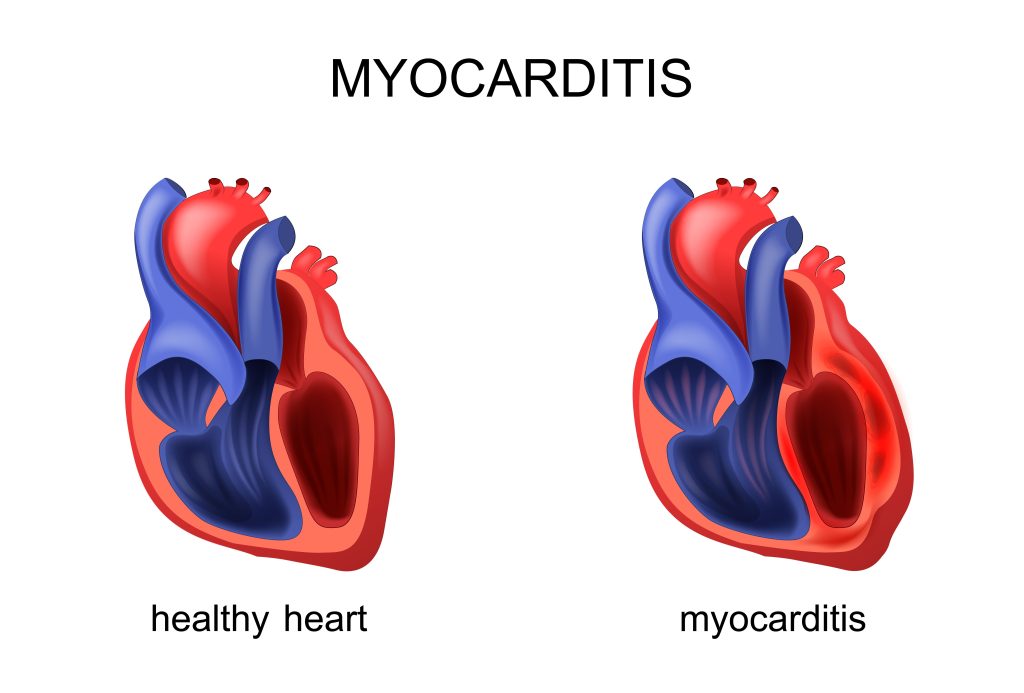 Baltimore Myocarditis Lawyer