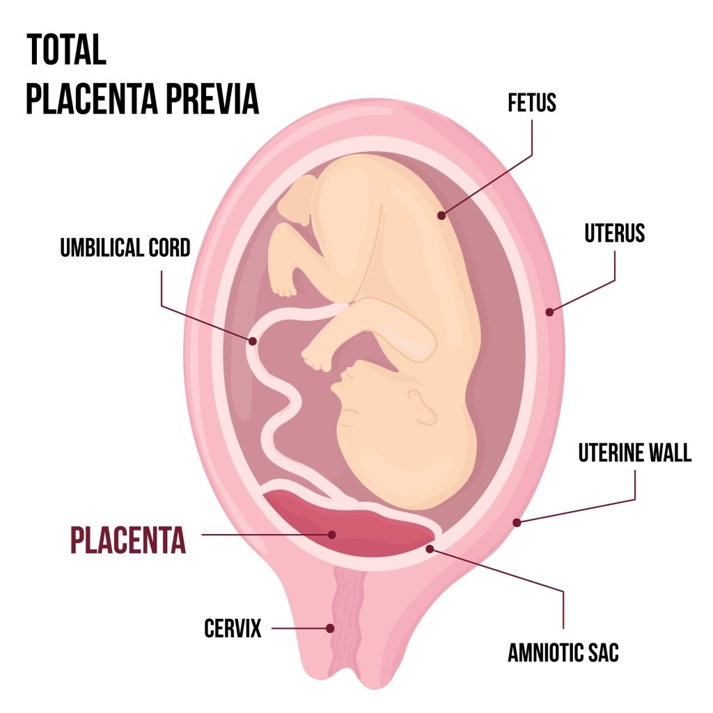 Baltimore Placenta Previa Lawyer